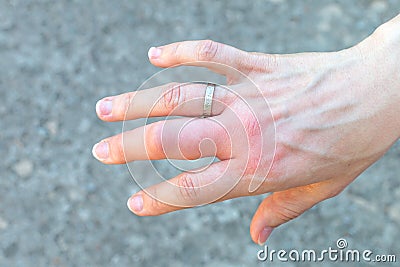 Reddened swollen finger after a bee sting Stock Photo