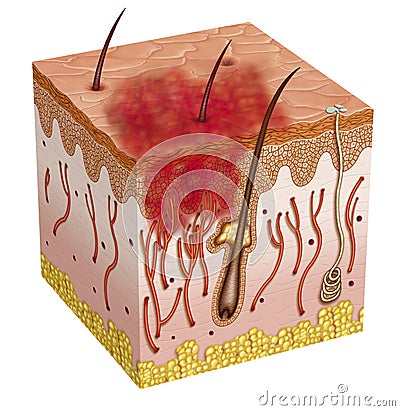 Carcinoma Stock Photo