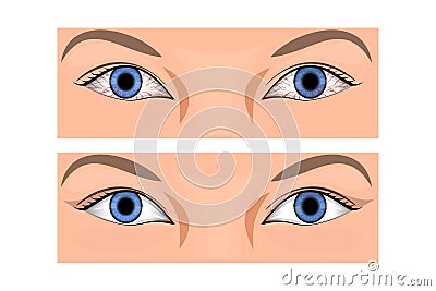 Redness of the eye Vector Illustration