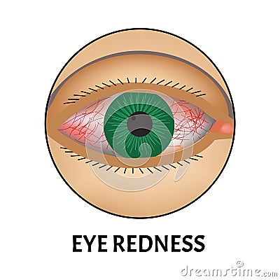 Redness of the eyes. Symptom of conjunctivitis, allergies, inflammation of the eyes. Eye redness icon. Infographics Vector Illustration