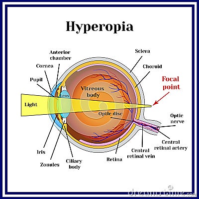 Refractive errors eyeball. Hyperopia. Medicine Vector Illustration