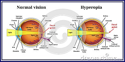 Refractive errors eyeball. Hyperopia. Medicine Vector Illustration