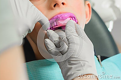 Registration of impressions and bites in a young teenager. Functional modern dental diagnostics Stock Photo