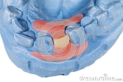 Removable incisor prosthesis Stock Photo