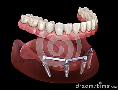 Removable Mandibular prosthesis with gum All on 4 system supported by implants. Medically accurate 3D illustration of human teeth Cartoon Illustration