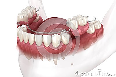 Removable partial denture, mandibular prosthesis. Medically accurate 3D illustration of prosthodontics concept Cartoon Illustration