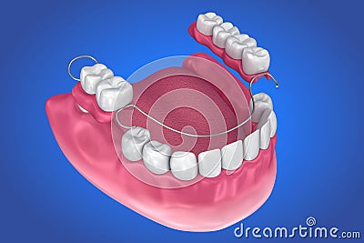 Removable partial denture. Medically accurate Cartoon Illustration