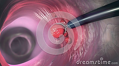 Removal of a colonic polyp with a electrical wire loop during a colonoscopy Cartoon Illustration