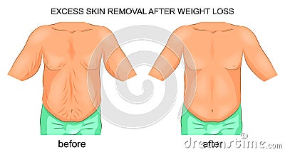 Removal of excess skin after weight loss Vector Illustration