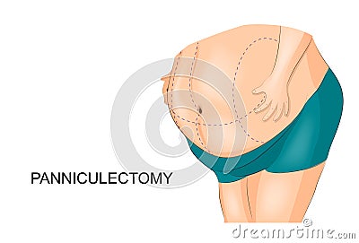 Removal of fat apron. panniculectomy Vector Illustration