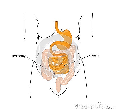 Removal of the large bowel and ileostomy Vector Illustration