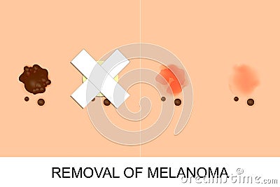 Removal of melanoma Vector Illustration