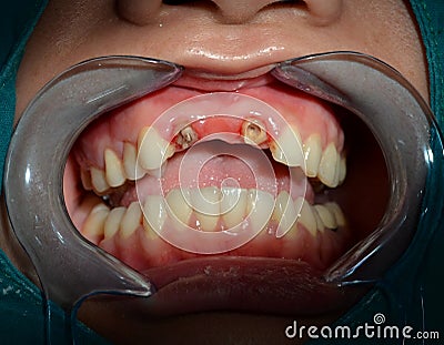 After remove all ceramic bridge of anterior upper teeth Stock Photo