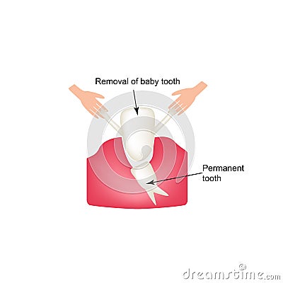 Removing baby teeth. Infographics. Vector illustration on isolated background Vector Illustration