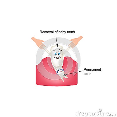 Removing baby teeth. Infographics. Vector illustration on isolated background Vector Illustration