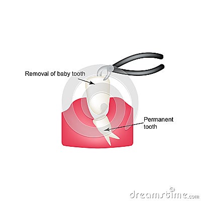 Removing baby teeth ticks. Infographics. Vector illustration on isolated background Vector Illustration