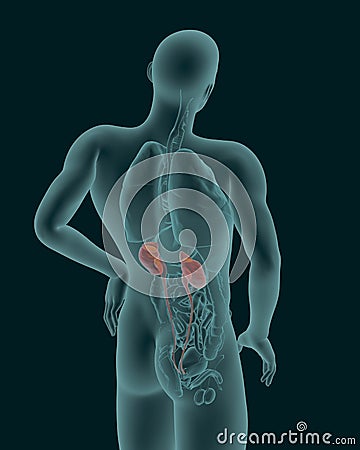 Renal colic-human urinary system 3d illustration Cartoon Illustration