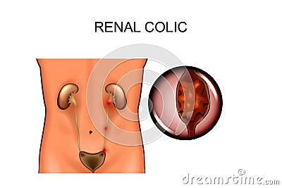 Renal colic. locations Vector Illustration