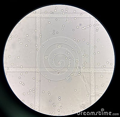 renal epithelial cell with rbc in Urine Stock Photo