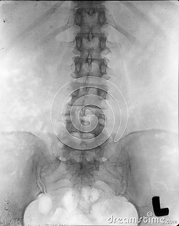 Renal pelvis spine xray (x-ray) Stock Photo