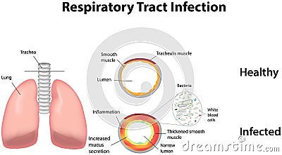 Respiratory Tract Infection Vector Illustration