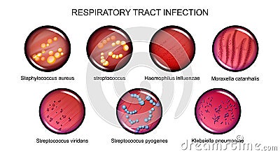 Respiratory tract infection Vector Illustration