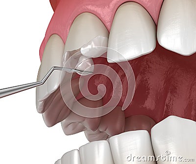 Restoration of broken tooth. Medically accurate 3D illustration Cartoon Illustration