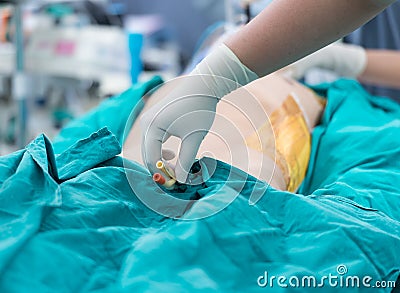 Retain foley catheter Stock Photo