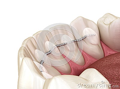 Retainers dental installed after braces treatment, Medically accurate dental 3D illustration Cartoon Illustration