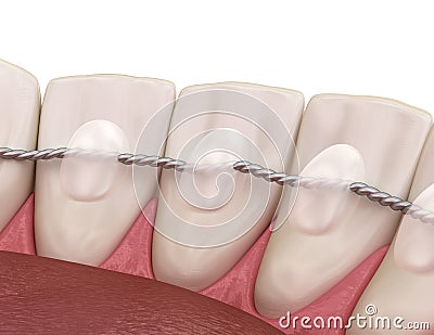 Retainers dental installed after braces treatment, Medically accurate dental 3D illustration Cartoon Illustration