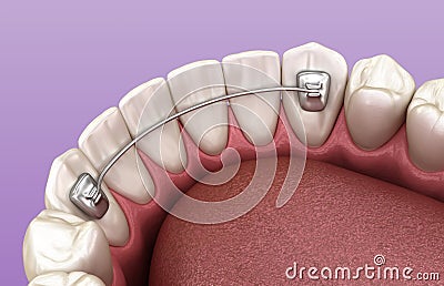 Retainers dental installed after braces treatment, Medically accurate dental 3D illustration Cartoon Illustration