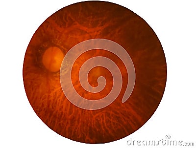 Retina of diabetes , diabates retinopathy,photo Medical Retina Abnormal isolated on white background.Saved with clipping path Stock Photo