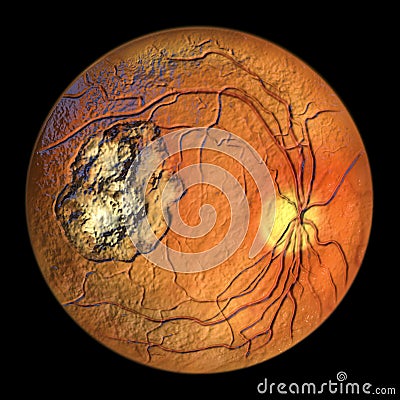 Retinal scar caused by a Toxoplasma gondii infection, or toxoplasmosis, 3D illustration Cartoon Illustration