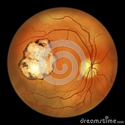 Retinal scar caused by a Toxoplasma gondii infection, or toxoplasmosis, scientific illustration Cartoon Illustration