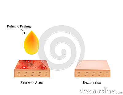 Retinoic peeling for acne. Inflamed skin acne. Acne purulent. The anatomical structure of the skin. Infographics. Vector Vector Illustration