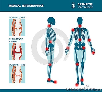 Rheumatism or rheumatic disorder medical posters. Arthritis joint pain. Rheumatology vector infographics Vector Illustration