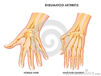 Rheumatoid Arthritis Vector Illustration