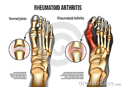 Rheumatoid arthritis Bones the of foot Vector Illustration