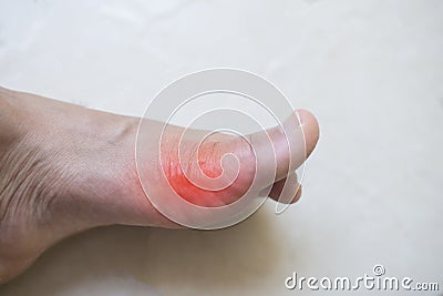 Rheumatoid Arthritis Stock Photo