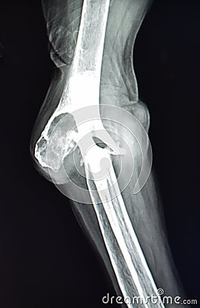 Rheumatoid arthritis finger xray pathology Stock Photo