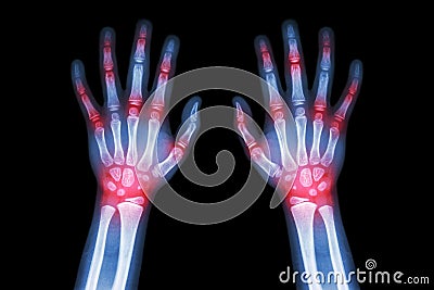 Rheumatoid arthritis , Gout arthritis ( Film x-ray both hands of child with multiple joint arthritis ) ( Medical , Science and He Stock Photo