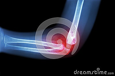 Rheumatoid arthritis , Gouty arthritis ( film x-ray child's elbow with arthritis at elbow ) ( Side view , Lateral ) Stock Photo