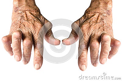 Rheumatoid Arthritis Stock Photo