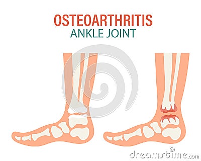 Rheumatoid arthritis. Osteoarthritis of the human ankle joints. Medical concept. Infographic poster, banner Vector Illustration