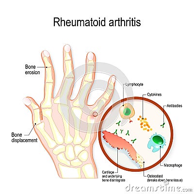 Rheumatoid Arthritis RA is an auto immune disease and inflammatory type of arthritis Vector Illustration