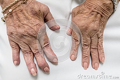 Rheumatoid Arthritis, Senior Hands Stock Photo
