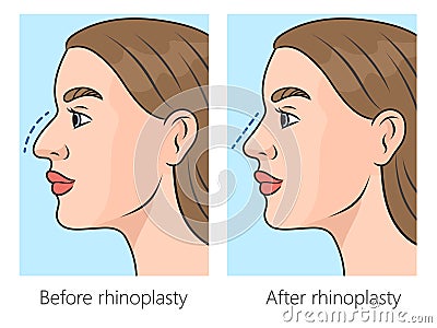 rhinoplasty for nose correction schematic Cartoon Illustration