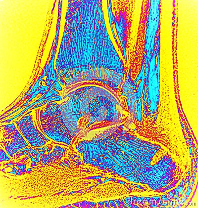 Right ankle after surgery haglund deformity mri Stock Photo