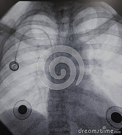 Right internal port via right jugular vein fluroscopy Stock Photo