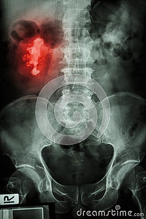 Right renal calculi (staghorn) Stock Photo